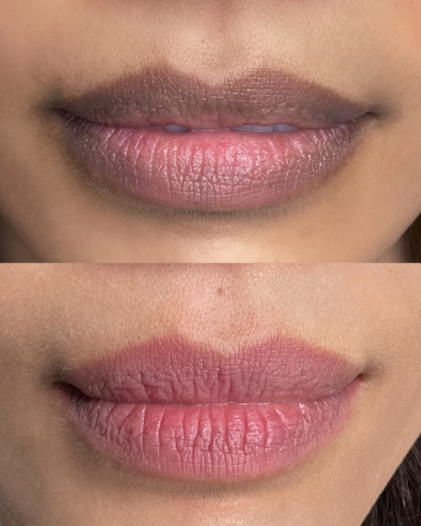 Before after neutralize healed