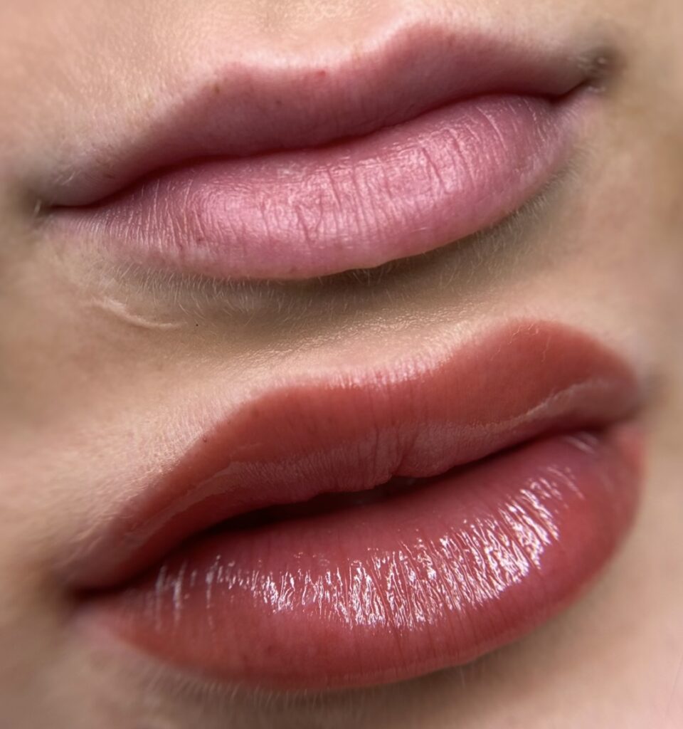 lipsbeforeafter